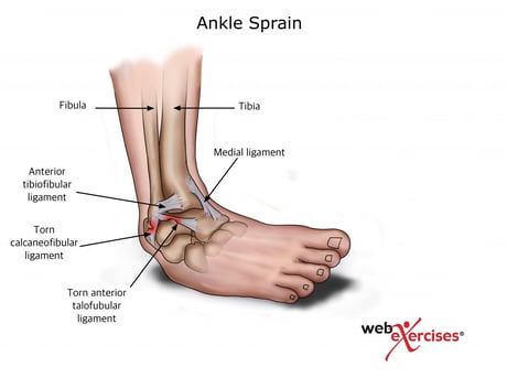 What are the best exercises for a sprained ankle?