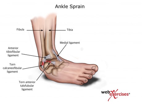 7 Easy Ankle Sprain Exercises to Start Running Early