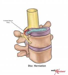 Lumbar Disc Herniation