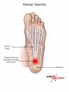 Plantar Fasciitis