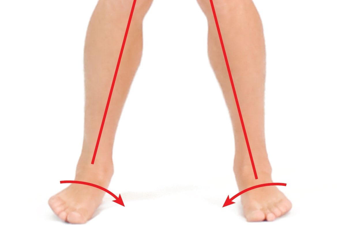 A Breakdown of Pronation Distortion Syndrome